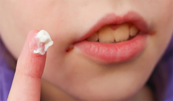 Чем лечить заеды в уголках рта?