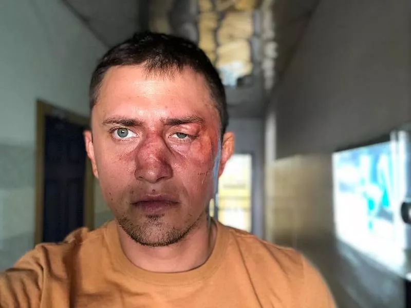 Прилучный показал изуродованное лицо после жестких слов о Муцениеце