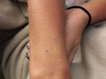 Родинка изменилась? Врачи называют 8 признаков, которые нельзя игнорировать