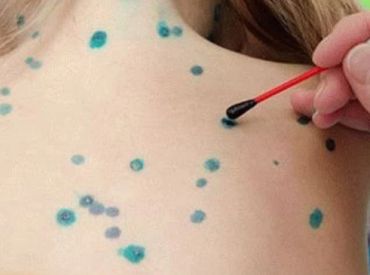 Turpmāk par inficēšanos ar pērtiķu bakām būs nekavējoties jāziņo SPKC