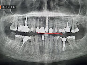 Saeimā turpinās vērtēt iniciatīvu par valsts līdzfinansējumu zobārstniecībai