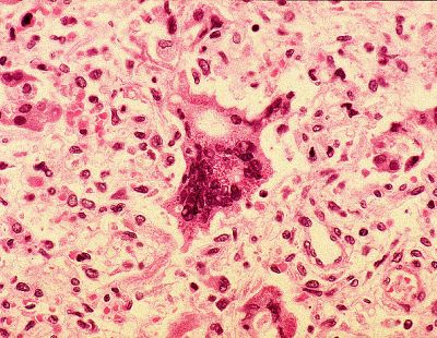 Корь в автобусе: под угрозой сотни пассажиров