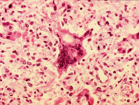 Корь в автобусе: под угрозой сотни пассажиров